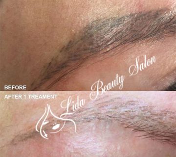 قوی ترین پاک کننده تاتو ابرو