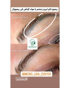 مركز تخصصی پاك كردن تاتو ابرو در کرج